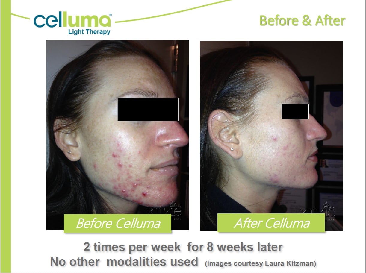 Celluma® Light Therapy in Derry, NH