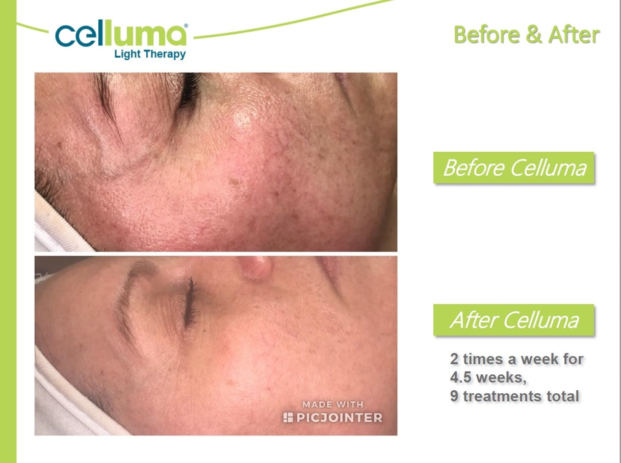 Celluma® Light Therapy in Derry, NH