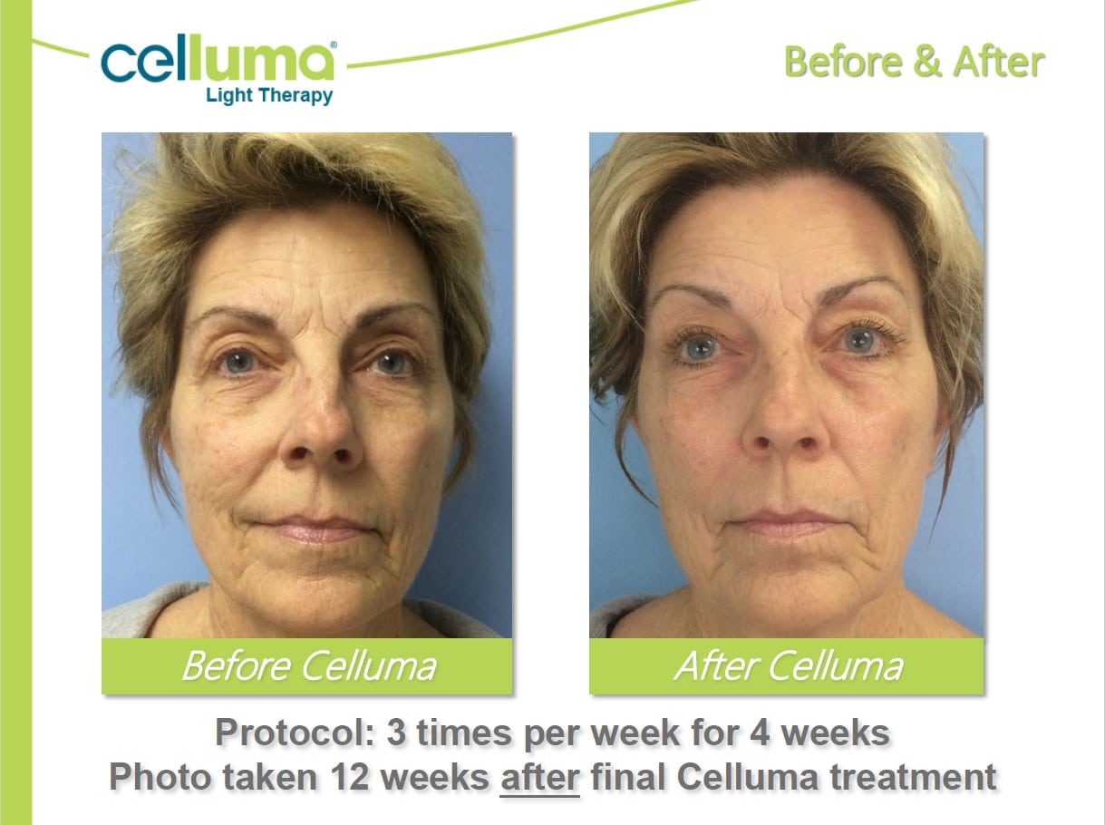 Celluma® Light Therapy in Derry, NH